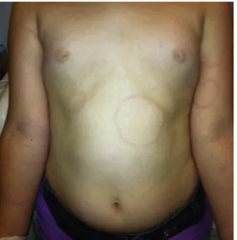Fig. 2 – Multiple circinate erythematous lesions with irregular shapes, scattered on the trunk and upper limbs.