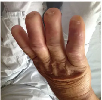 Fig. 1 – Skin thickening and resorption of distal phalanges.