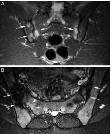 Figura 2 – A, corte coronal de RM ponderada em T2 com saturac¸ão do sinal de gordura evidencia edema da medular óssea nos terc¸os superior e médio das articulac¸ões