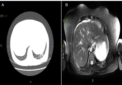 Figura 1 – Respectivamente, TC de tórax e RM pulmonar de paciente com ES. A, observa-se área de atenuac¸ão em “vidro fosco” no lobo inferior do pulmão esquerdo; B, nota-se área de aumento de sinal em T2 na área correspondente.
