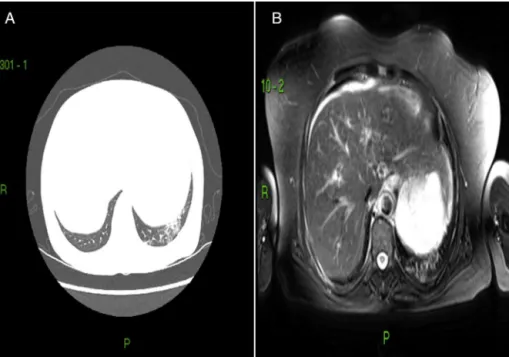 Fig. 1 – Respectively, chest CT and chest MRI of patient with SSc. A, shows ground-glass attenuation area in the lower lobe of the left lung; B, shows an area of T2 increase in the corresponding area.