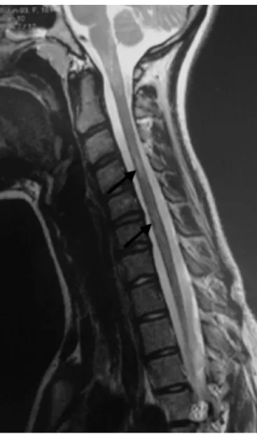 Fig. 1 – Sagittal magnetic resonance image. T2-weighted cervical spinal cord showing a long hyperintense spinal cord lesion (black arrow) in an adolescent girl with juvenile dermatomyositis.
