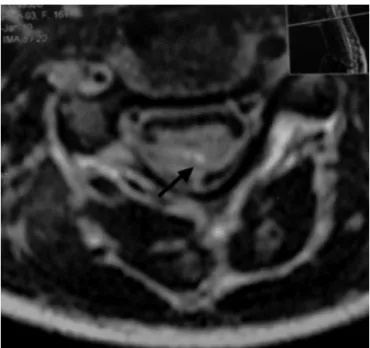 Fig. 2 – Axial magnetic resonance image of the cervical spine (C3) showing a long hyperintense spinal cord lesion (black arrow) in an adolescent girl with juvenile