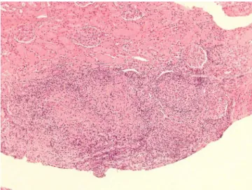Fig. 2 – Focal granulomatous interstitial nephritis according to Hematoxylin–Eosin coloring.