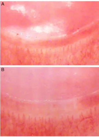 Fig. 2 – Capillaroscopy (October, 2013). Nailfold
