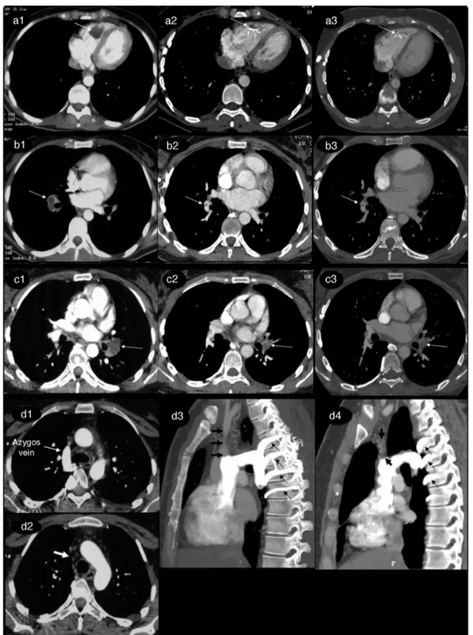 Fig. 1 – Five-year computed tomography angiography (CTA) follow-up of thrombi in the intracardiac region, the superior vena cava, and both pulmonary arteries.