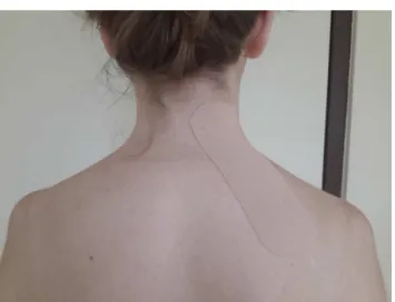 Fig. 1 – Kinesio Taping technique.