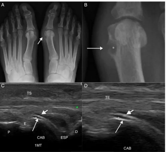 Figura 1 – A, radiografia anteroposterior dos pés de um paciente com gota que mostra aumento do volume e da densidade de partes moles junto à 1 a articulac¸ão MTF (seta)