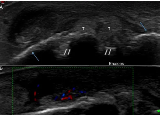 Figura 3 – A, imagem ultrassonográfica no plano longitudinal no 1 ◦ metacarpo. Paciente com quadro de dor sem evidências de crise gotosa