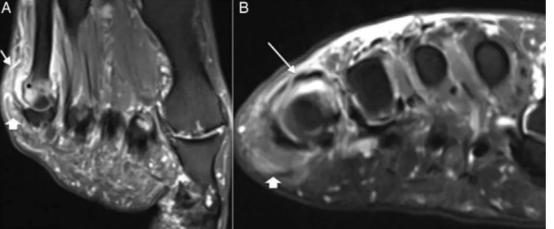 Figura 4 – Imagens de RM do pé no eixo longo (A) e no eixo curto (B) que mostram derrame articular (seta) na 5 a articulac¸ão metatarsofalângica, associada a padrão de edema ósseo medular na cabec¸a e metáfise distal do 5 o metatarso (*), além de densifica