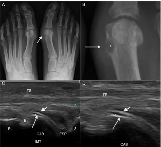 Fig. 1 – (A) Anteroposterior radiography of feet of a patient with gout showing increased volume and density of soft tissues adjacent to the first metatarsophalangeal (MTP) joint (arrow)
