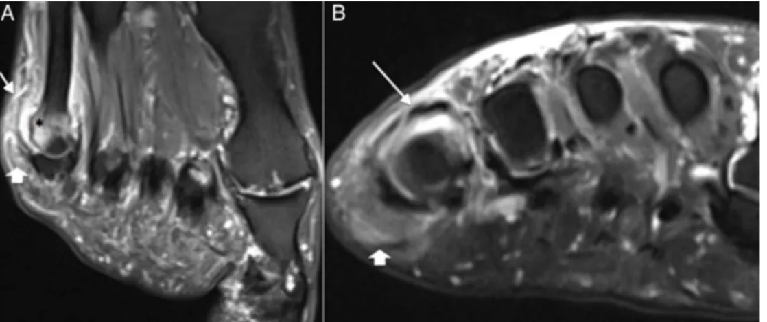 Fig. 4 – MRI images of the foot on the long (A) and short (B) axis, showing joint effusion (arrow) in the fifth