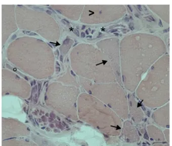 Fig. 2 – Filling defects of segmental branches of the right lower lobe and left lower lobe due to pulmonary thromboembolism.