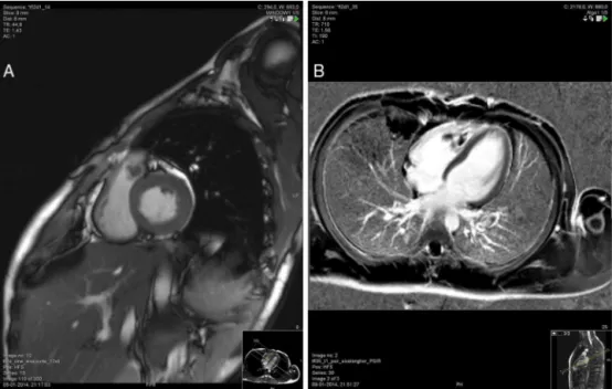 Fig. 1 – Contrast-enhanced cardiac MRI with thrombi visible in the right ventricle outflow tract (A), and in the right ventricle (B).