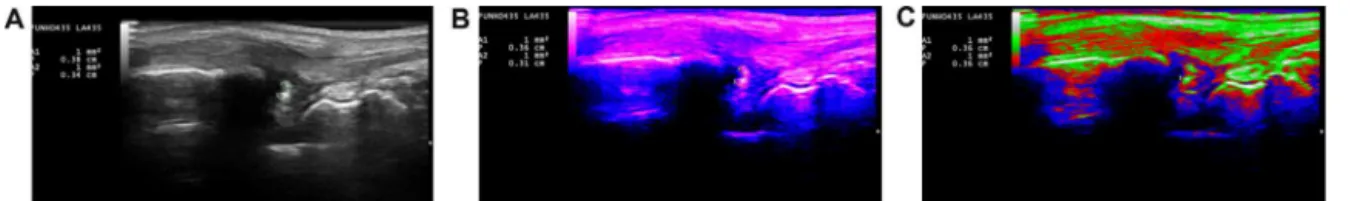 Fig. 2 – (A–C) Area measurements, in cm 2 of calcifications in the triangular fibrocartilage complex of the wrist in a patient with Chondrocalcinosis – calcifications assessment by gray scale patterns, Indigo and RGB, respectively, confirmed the presence o
