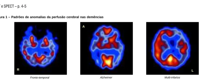 Figura 1 – Padrões de anomalias da perfusão cerebral nas demências