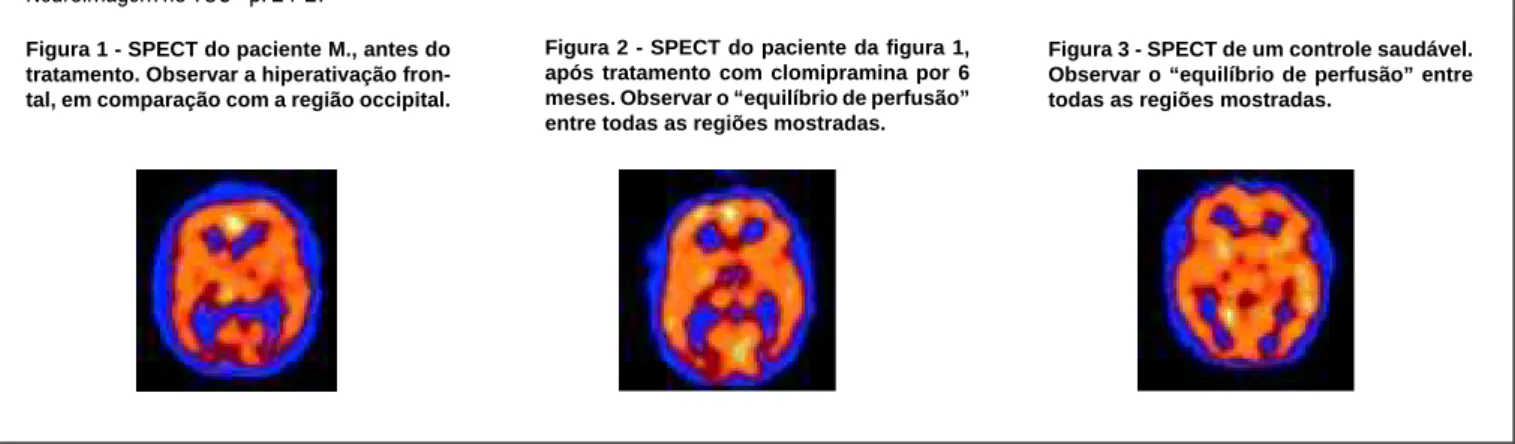Figura 1 - SPECT do paciente M., antes do tratamento. Observar a hiperativação  fron-tal, em comparação com a região occipital.