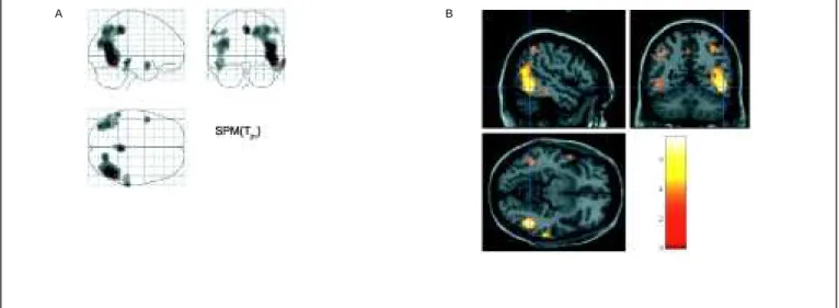 Figura -  (A) Mapa paramétrico estatístico mostrando, em três eixos, os voxels cerebrais nos quais se observou diminuição de fluxo sanguíneo cerebral regional num paciente de 65 anos com diagnóstico clínico de doença de Alzheimer provável em comparação com