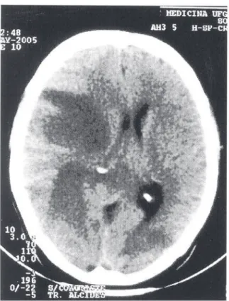 Figure 1 – CT showing right frontal and parietal  hypodensity