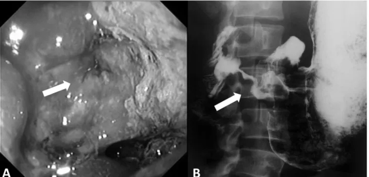 Figure 1: A: Upper digestive endoscopy identifying an ulcerative lesion (arrow) in the stomach, edema, hyperemia and thick ibrine; B: Barium  swallow exam displaying distended stomach, concentric stenosis of gastric antrum, pylorus and irst portion of duod