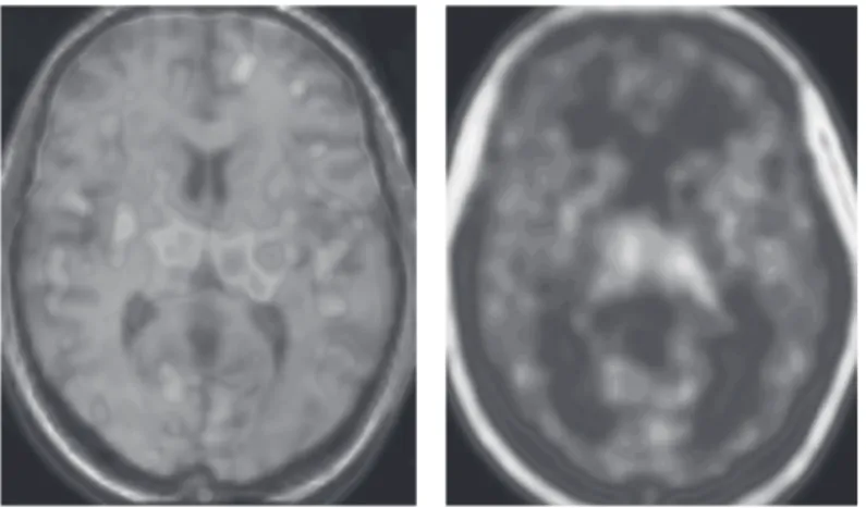 Figure 3 Representative PET parametric image of [ 11 C] 
