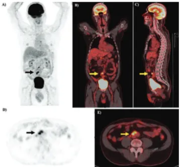 Figure 3 An example of  18 F-FDG PET/CT application in  Neurology. A female patient with mild cognitive impairment  (MCI) who had a PET/CT scan performed