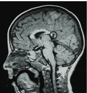 Figure 1  MRI scan showing circumscribed hypoplasia  of the splenium portion of the corpus callosum.