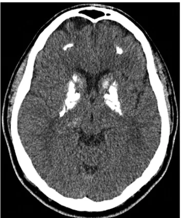 Figure 1 Patterns of brain calcifications often found in patients with idiopathic basal ganglia calcification