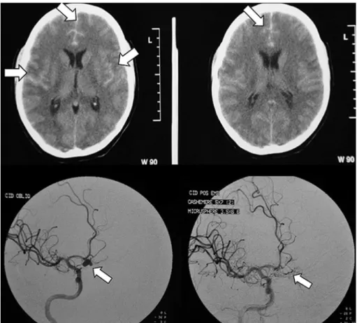 Figure 1 Head computed tomography scan revealing frontal subarachnoid hemorrhage and cerebral angiography showing two aneurysms, before and after endovascular coiling.
