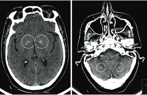 Figure 1 Axial computed tomography scans of the head showing calcifications in the globi pallidi (left) and dentate nuclei (right).