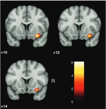 Figure 1 Reduced gray matter volume (GMV) in patients with bipolar disorder type I (BD-I) and a lifetime history of hallucinations (n=9) as compared to those with the same condition but no history of hallucinations (n=12) (significant at z 4 2.33, uncorrec