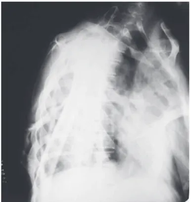 Figure 5 –  6KRUWHQLQJRIWKHKDOOXFHV