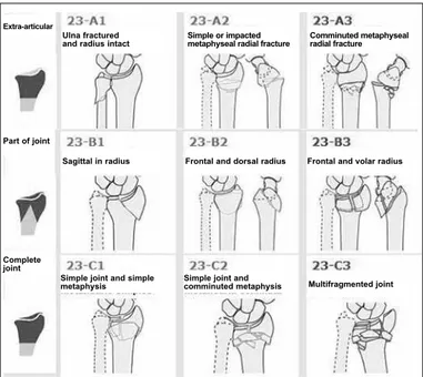 figure 1 – AO classification for fractures of the distal radius (27) .