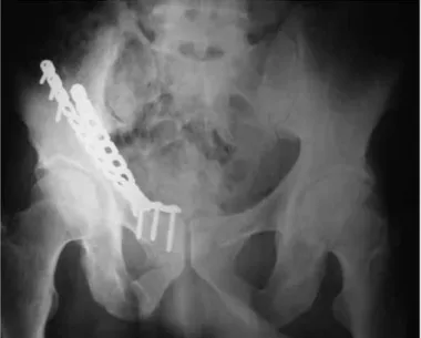 table 6 – Distribution of type of access in relation to type of fracture.