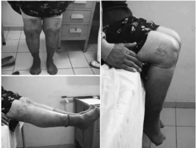 figure 1 –  Postoperative clinical evaluation (15 years, right knee; 