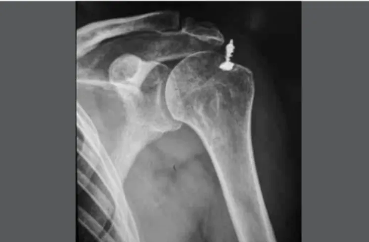 figure 1 –  X-ray  in  AP  view  of  left  shoulder  of  patient  who  underwent  arthroscopic  repair  rotator  cuff  lesion  (patient  12,  group II), showing loosening of anchor (see text).