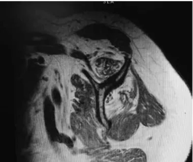 figure 2 –   Sagittal  T1-weighted  magnetic  resonance  image  of  left  shoulder,  showing  atrophy  and  fatty  degeneration  of  the  supra  and  infraspinatus tendons.