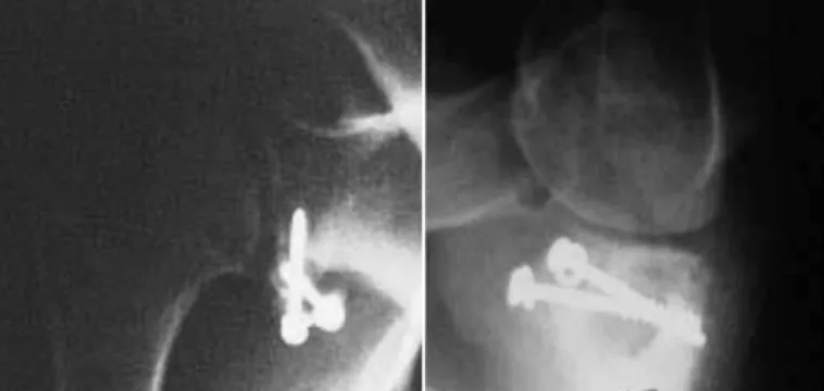 figure 5 – Simple radiograph in corrected AP and Bernageau  views showing incorrect positioning of the screws due to  incorrect positioning of the graft (more inferiorly than it should  have been).