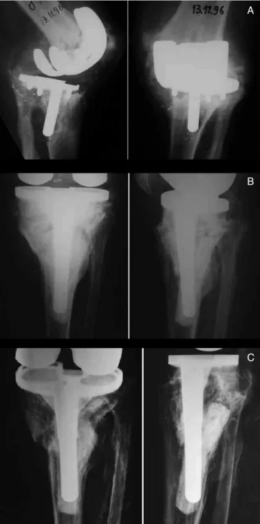 Figure 3 – Radiographic evolution of prosthesis loosening. Note the  posterior cortical reaction and nail migration