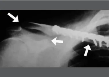 Figure 5 – Perioperative radioscopy. Note the anatomical reduction of the  clavicular fracture and the normal coracoclavicular distance.
