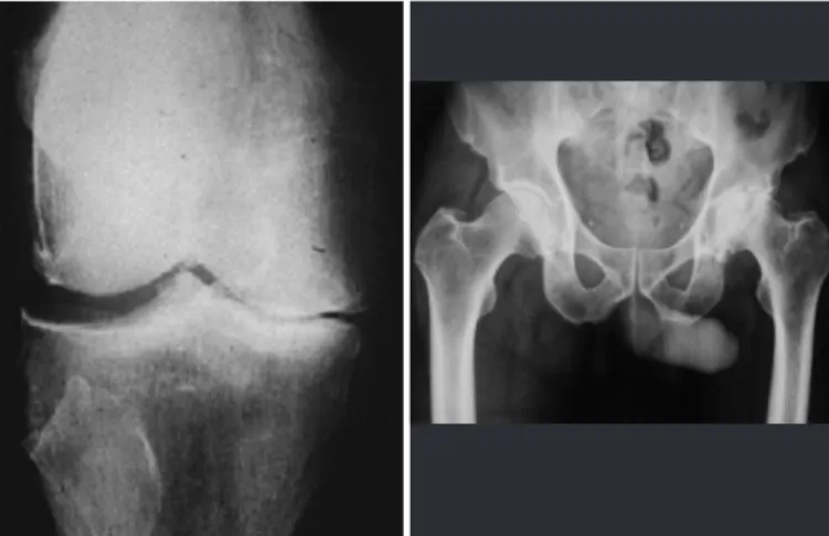 Figure 8 – Osteochondral lesion of the talus.
