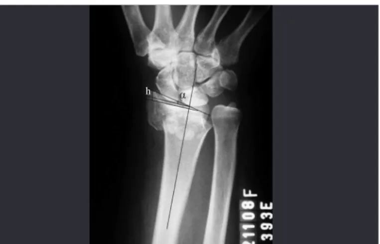 Figure 1 –  Preoperative radiograph on wrist in posteroanterior  (PA) view, showing an extra-articular fracture of the distal radius  with metaphyseal comminution and diminished radial inclination
