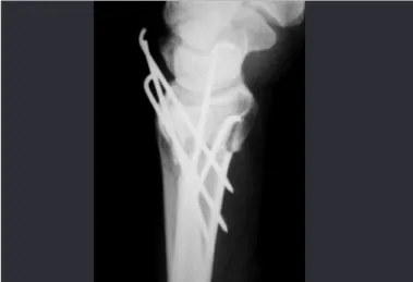 Figure 4 –  Radiograph  on  wrist  showing  the  immediate  postoperative result in lateral view, with correction of the dorsal  deviation of the distal radius.
