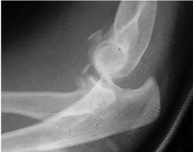 Figure 1 –   Lateral-view  radiograph  of  elbow,  demonstrating 