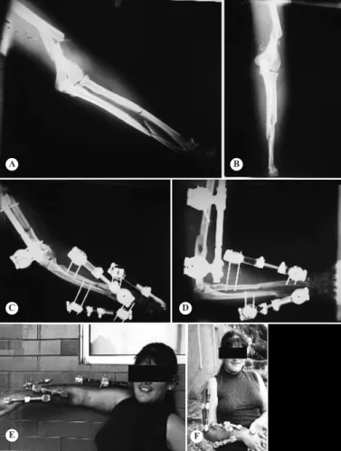 Figure 7 –  Patient 3. Images A and B show radiographs on  the initial trauma (“floating elbow”