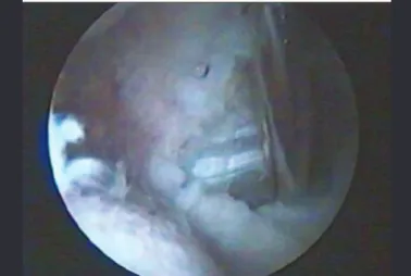 Figure 7 –  Snout-like spacer for anterior soft tissue.