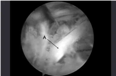 Figure 2 -  A) Parts of the transverse ligament of the scapula; (B)  Suprascapular nerve.