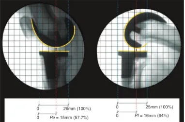 Figure 1 –  Image showing determination of the point of peak load- load-bearing in extension and flexion, for calculating the rollback rate