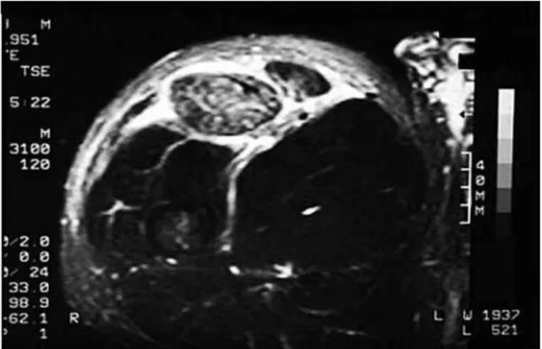 Figure  4  –  Magnetic  resonance  imaging  on  intra  and  extra- extra-compartment muscle injury