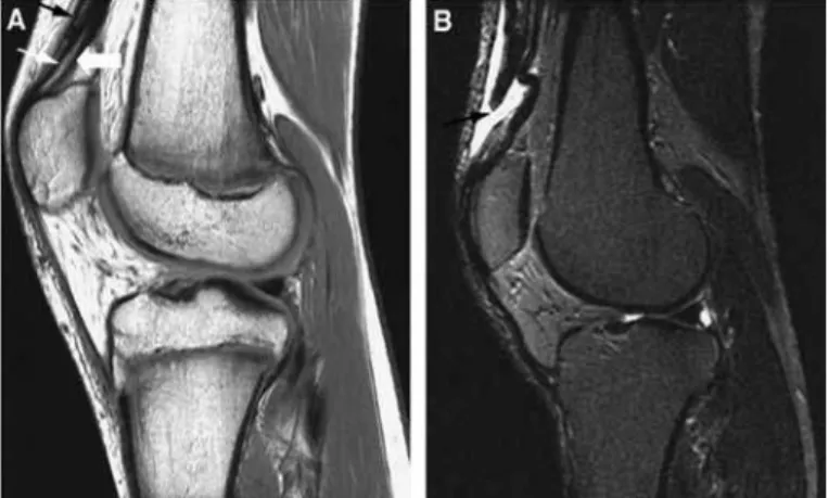 Figure 6 –  Magnetic resonance imaging in sagittal plane with t1  weighting (A) and t2 weighting (b), showing quadriceps tendon injury.